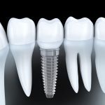 Tooth human implant (done in 3d graphics)