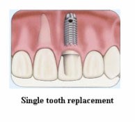 denta-health-dental-implants-1 denta-health-dental-implants-1