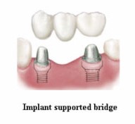 denta-health-dental-implants-2 denta-health-dental-implants-2