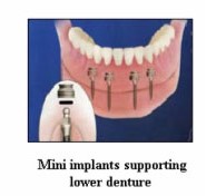 denta-health-dental-implants-3 denta-health-dental-implants-3