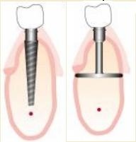 dental-implant-crestal-and-basal dental-implant-crestal-and-basal