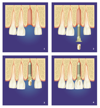 advantages-of-dental-implants