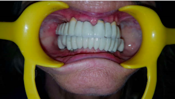 denta-health-full-mouth-replacement-dr-anita