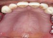 denta-health-impression-post-splinted-with-pattern-resin-and-before-pick-up-impression