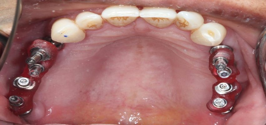 denta-health-impression-post-splinted-with-pattern-resin-and-before-pick-up-impression