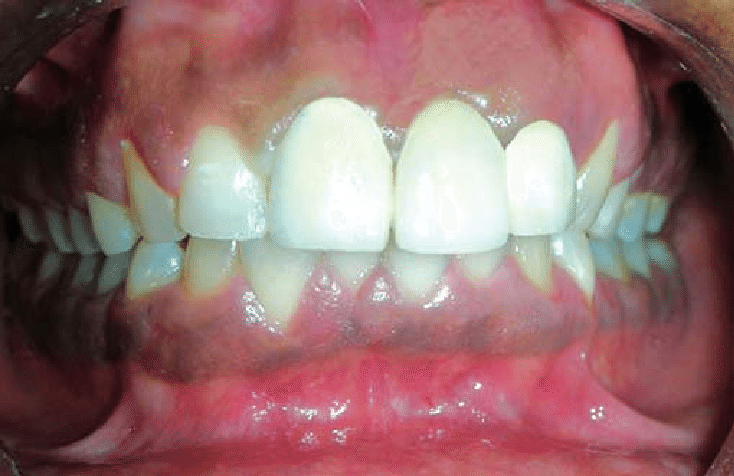 denta-health-intaglio-surface-of-final-prosthesis-showing-modified-ovate-pontic-dr-anita