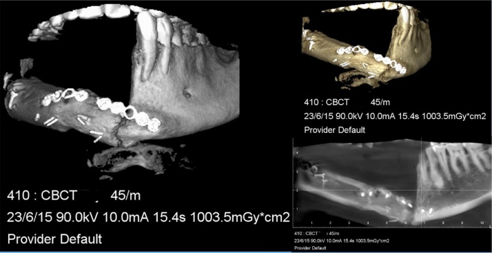 denta-health-mandibular-reconstruction
