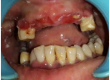 denta-health-aggressive-periodontitis