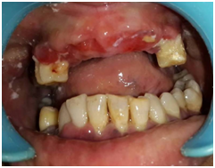 denta-health-aggressive-periodontitis