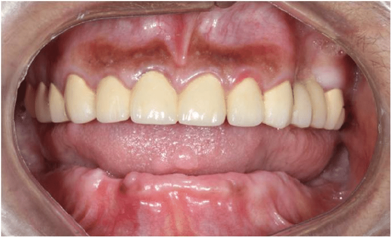 denta-health-immediate-loading-publication