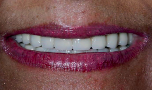 denta-health-strategic-implants-publication